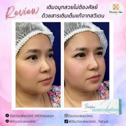 Filler จมูก