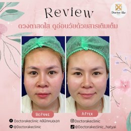 Filler ใต้ตา