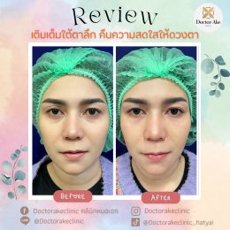 Filler ใต้ตา