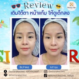 Filler ใต้ตา
