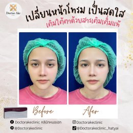 Filler ใต้ตา