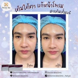 Filler ใต้ตา
