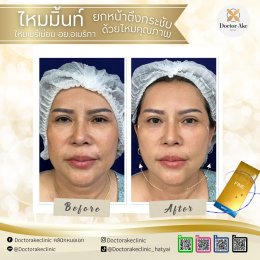 ร้อยไหม Premium Mint Lift