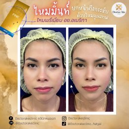 ร้อยไหม Premium Mint Lift