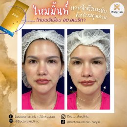 ร้อยไหม Premium Mint Lift