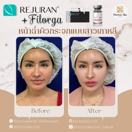 Rejuran+Filorga