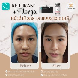 Rejuran+Filorga