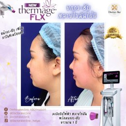 Thermage FLX