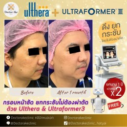 Ultherapy SPT