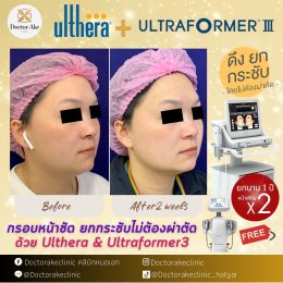 Ultherapy SPT