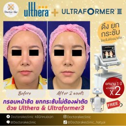 Ultherapy SPT