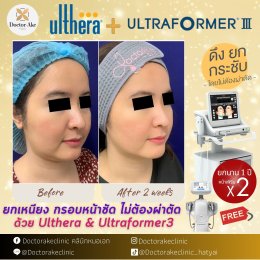 Ultherapy SPT