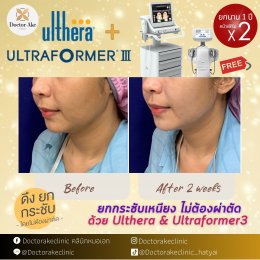 Ultherapy SPT