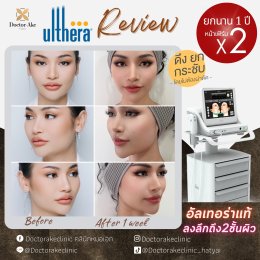 Ultherapy SPT