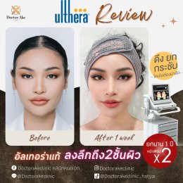 ulthera อัลเทอร่า ยกกระชับหน้า หาดใหญ่