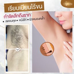 Fotona เลเซอร์กำจัดขน