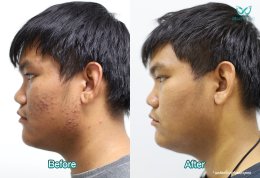 รักษาสิว Acne Scar Clear