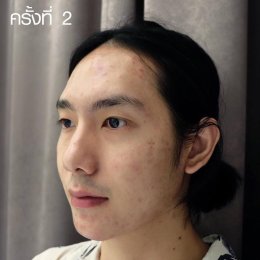 ACNE MASK