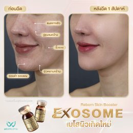 Exosome เมโสผิวเกิดใหม่