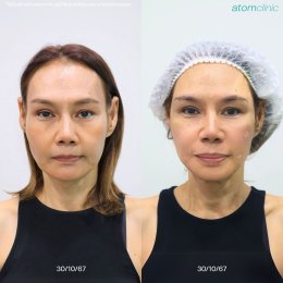 รีวิว ฟิลเลอร์ จากผู้รับบริการจริง