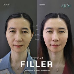 filler ฟิลเลอร์ เทคนิค AT Tri 
