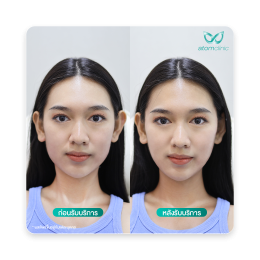 รีวิว Nano Lipofat