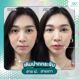 ฟิลเลอร์ ปรับรูปหน้า เปลี่ยนหน้าโทรมให้ กลับมาหน้าเด็ก