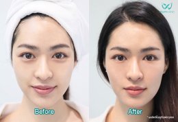 รีวิว PRP Youthful