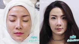 รักษาสิว และรอยสิว ครบจบไม่ต้องจ่ายเพิ่ม ACNE SCAR CLEAR