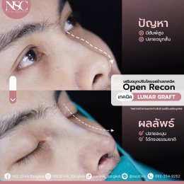 เสริมจมูกOpen Recon 6