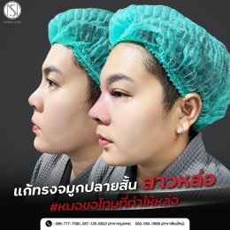 รีวิวเสริมจมูก ทอมหล่อ