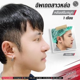 รีวิวเสริมจมูก ทอมหล่อ