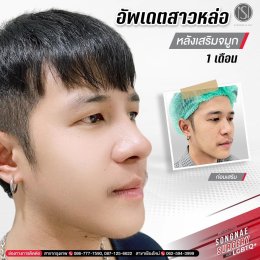 รีวิวเสริมจมูก ทอมหล่อ