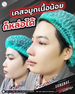รีวิวเสริมจมูก ทอมหล่อ
