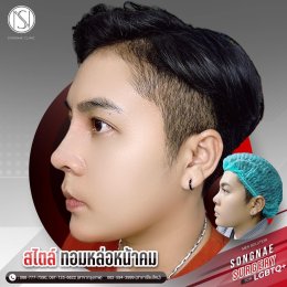 รีวิวเสริมจมูก ทอมหล่อ