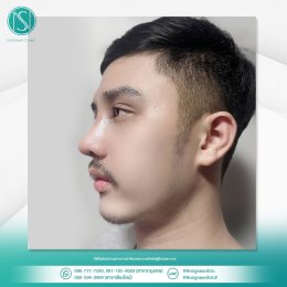 รีวิวเสริมจมูก ผู้ชาย