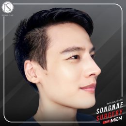 รีวิวเสริมจมูก ผู้ชาย