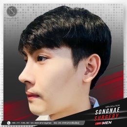 รีวิวเสริมจมูก ผู้ชาย