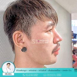 รีวิวเสริมจมูกผู้ชาย09_2021