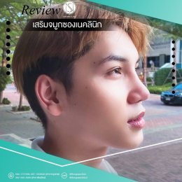 รีวิวเสริมจมูกผู้ชาย SongnaeClinic