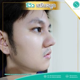 รีวิวเสริมจมูกผู้ชาย_Songnae_Clinic