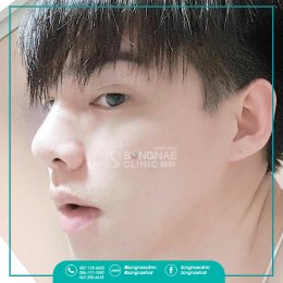 เสริมจมูก ผู้ชาย