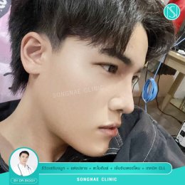 ทำจมูกผู้ชายหล่อเป็นธรรมชาติ