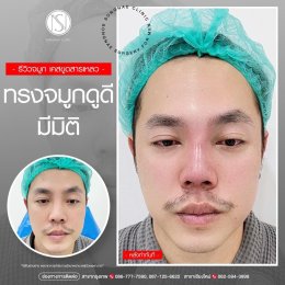 แก้จมูก 