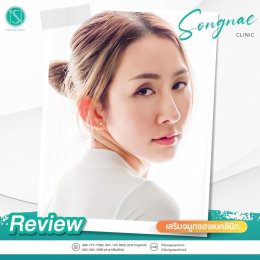 รีวิวเสริมจมูก ผู้หญิง2
