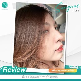 รีวิวเสริมจมูก ผู้หญิง2