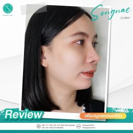 รีวิวเสริมจมูก ผู้หญิง2