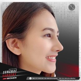 รีวิวเสริมจมูก ผู้หญิง2