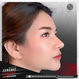 รีวิวเสริมจมูก ผู้หญิง2