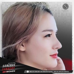 รีวิวเสริมจมูก ผู้หญิง2